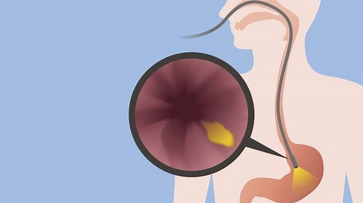 L’endoscopie : définition, indications et déroulement