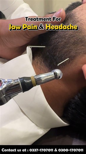 Dry Needling for Jaw Pain & Headache Relief | TMJ Treatment