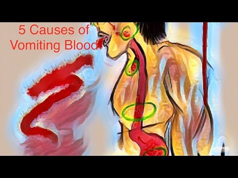 5 Causes of Vomiting Blood