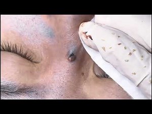 Deep Blackhead & Cyst Extraction – So Satisfying to Watch!