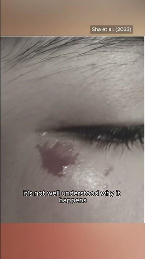 Haematohidrosis - When You Sweat Blood