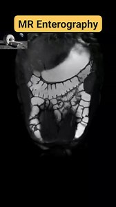 3.1K views · 32 reactions | MR Enterography | CT Scan and MRI study | Facebook