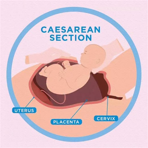 1.3K views | 喙 C-Section Facts  A Cesarean section (C-section) is a...