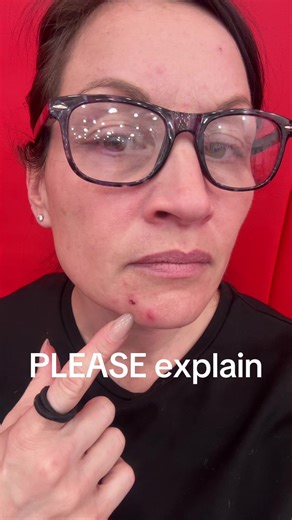 How??? Why??? 46 year olds should NOT be getting acne like a teenager 46 going on 16 😵‍💫 Big feelings. Big pores. 🤦🏻‍♀️🤷🏻‍♀️ #BigFeelings #Over40Life #ParentLife #TeacherLife #UnhingedEnergy