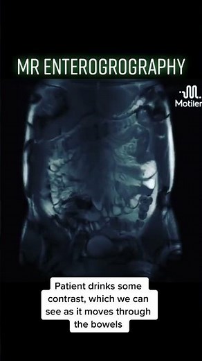 MR Enterography to look at the bowels
