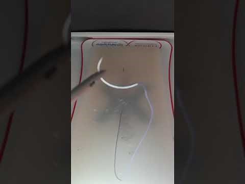 Laparoscopic intracorporeal suture: Gladiator technique from Dr Romeo.