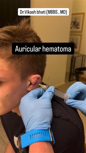 Dr. Vikash Bhati 🩺 on Instagram: "An auricular hematoma is a collection of blood in the pinna (external ear). It’s usually caused by blunt trauma to the ear, such as from a glancing blow, accident, or contact sport. #hematoma #blood #cauliflowerear #sportsinjury #blunt #trauma #auricular #auricularhematoma #ent #entsurgeon #doctor #viral #medico #nurse #explore #insta"