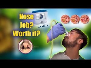 Vivaer Nasal Airway Remodeling Surgery