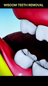 8.7K views · 50 reactions | wisdom teeth removal #WisdomTeeth #WisdomTeethRemoval #ToothExtraction #OralSurgery #DentalHealth #WisdomTooth #HealthySmile #PostOpCare #ToothPainRelief #WisdomTeethRecovery #DentalCare #WisdomTeethProblems | Surgery Page | Facebook