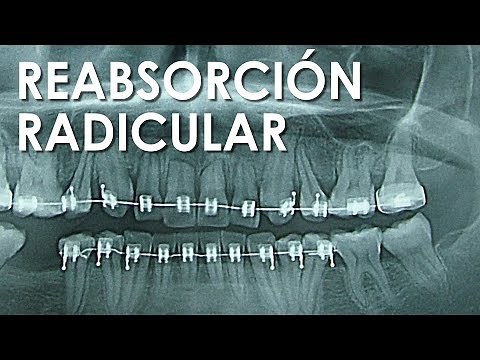 REABSORCIÓN RADICULAR | ¿PERDERÉ MIS DIENTES?