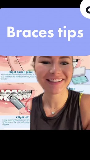 Braces Tips: Managing Pokey Wires and Broken Bands