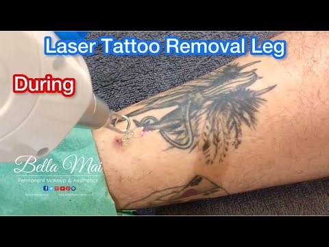 Laser Tattoo Removal Leg - Before, During & after 6 Weeks Healed