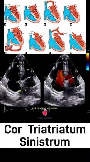 Cor Triatriatum Sinistrum #CorTriatriatum #CongenitalHeartDisease #CardiacEcho