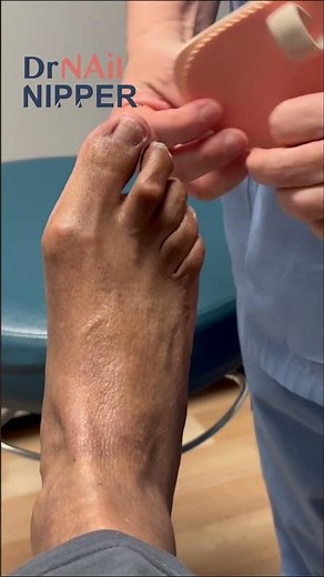 Hammertoe Splint Short #hammertoes #toesperandonosenhor #toenailcare