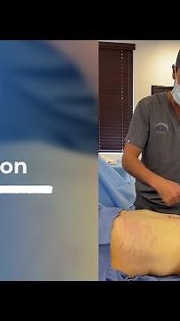 Male Liposuction