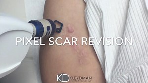 Scar Removal Treatment Using Pixel Lasers