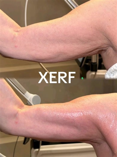 ✨хerғ✨ If you’re questioning how these before & afters are only an hour apart… same 🤯 but I saw it in real time. I’m still not over these results. And this is just the beginning. Scroll for the video. XERF creates this change by delivering deep thermal energy into the dermis, triggering collagen and elastin stimulation/tightening. Skin density and resilience is renewed. . #xerf #skintightening #medicalaesthetics #injector #laser