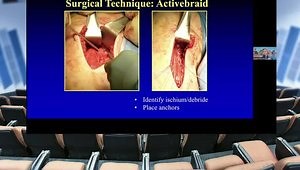 Acute Proximal Hamstring Rupture: Open Fixation with Low-Profile Soft Anchors for Multi-Point Repair