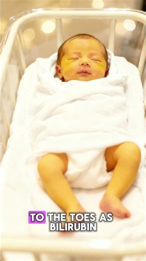 How Doctors Check Jaundice in Newborns?