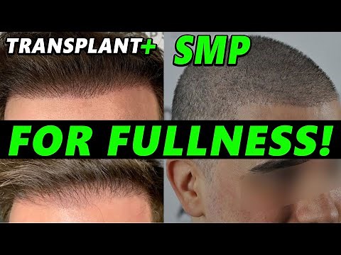 Hair Transplant Enhancement with SMP - 3 Ideal Cases To Do It! Scalp Micropigmentation