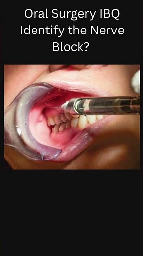 Nerve Blocks Oral Surgery #neetmds #dentist #bds #anaesthesia #mds #surgeon