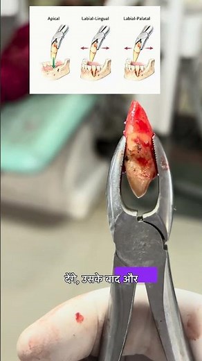 Technique for extraction of canine tooth