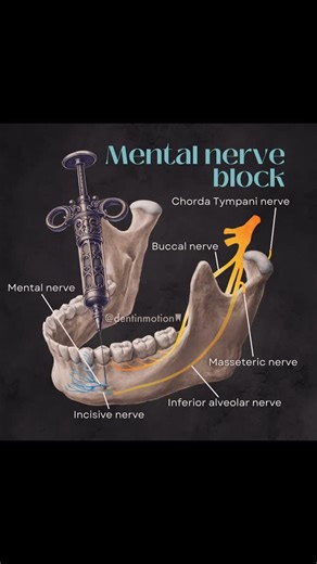 @toothtipss | The mental nerve block is a simple and effective technique to anesthetize the chin, lower lip, and buccal mucosa anterior to the premolars.... | Instagram