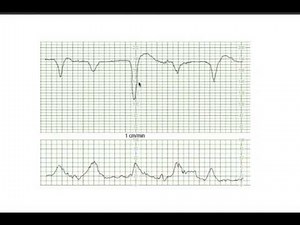 Decelerations Complicated Variables