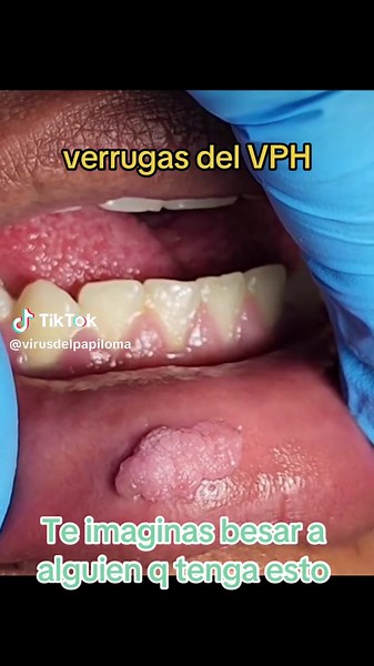 Verrugas del VPH en la Lengua: Síntomas, Cáncer Oral y Tratamiento