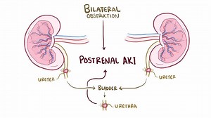 Video: Postrenal azotemia - Video Explanation! | Osmosis | Osmosis