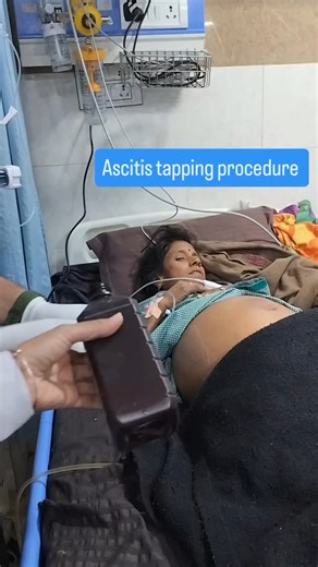 Ajammeel Khan on Instagram: "Ascitis tapping procedure (Paracentesis procedure) #ascitis #paracentesis #doctor #medical #icu #emergancy #nurse #anm #mbbs #mbbslife #mbbsdiaries #mbbsstudent #mbbsabroad #medicalschool #medical #mumbai #delhiuniversity #aligarh #instagood #instagram #instagramreels #réel #reel #reelindia❤️ #trandingreels"