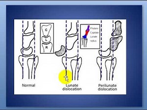 Perilunate and lunate dislocations