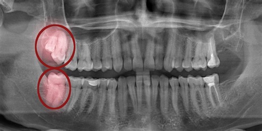 Why impacted wisdom teeth are so dangerous