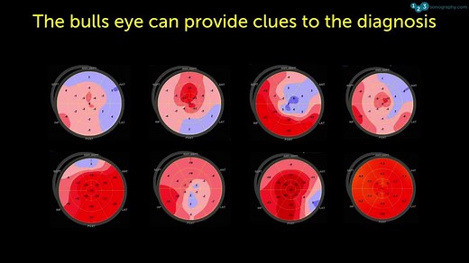 60 Seconds of Echo Teaching: Can You tell which pathology is present from the bulls eye display of Speckle Tracking Echo? Speckle Tracking can be really helpful - and guess what? We now also have an online course on Speckle Tracking for you: https://www.123sonography.com/eb-speckle-tracking | 123sonography