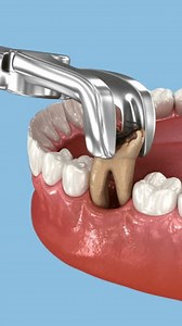 Extraction Tooth Dental 3d Animation Stock Footage Video (100% Royalty-free) 3894815269 | Shutterstock