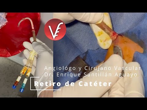 Removal of Palindrome Catheter (tunneled) - Dr. Enrique Santillán Angiologist and Vascular Surgeon.