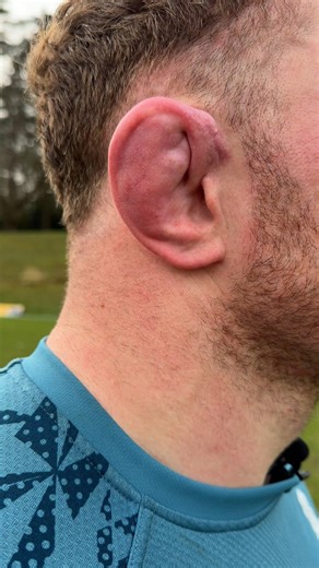 The Cauliflower Ear 😳👂 | England Rugby