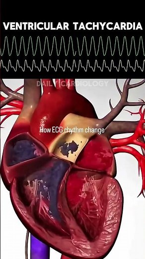 ECG Rhythm Changes Explained in 60 Seconds | Normal Sinus to Asystole | Heart Animation 💓 #shorts