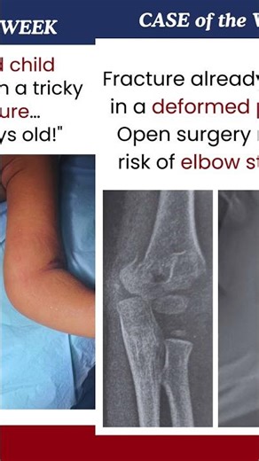 Case of the Week - Late Presenting Elbow Fracture