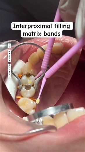 Interproximal filling matrix bands