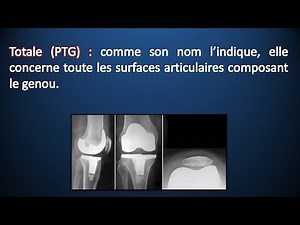 Rééducation d'une Prothèse Totale du Genou (PTG)