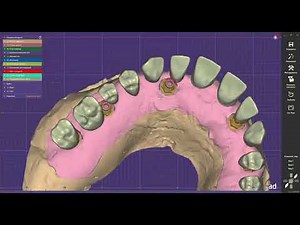 Exocad How prefect big total work can you make with multi units dentium.Tutorial