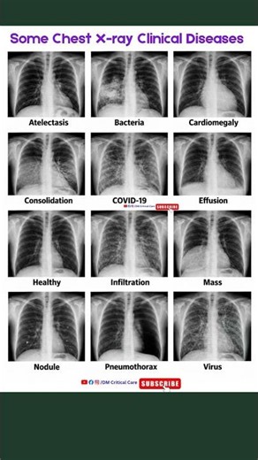 Some Clinical Diseases of Lungs in Chest X-ray|Chest X-ray of Lung Diseases|DM Critical Care #xray