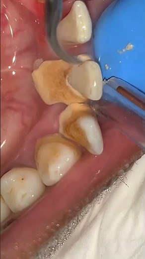 Extreme Tartar Removal ASMR | Deep Teeth Cleaning & Yellow Teeth Transformation