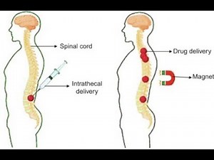 Intrathecal Route of Drug Administration ; Uses, Procedure, Advantages, Disadvantages