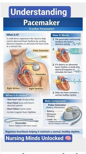 Understanding Pacemakers #pacemaker #heart #medicalstudent #medical #nursingstudent #nursing #gnm