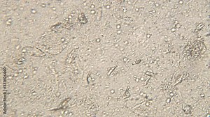 Microscopy of human sperm . Magnification 150x moving of spermatozoides in detail under microscope.