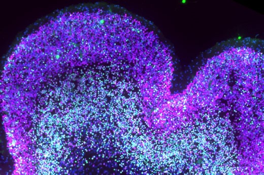 Scientists Map How Down Syndrome Reshapes Brain Development Before Birth | Newswise