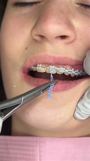 Sky Blue Braces Color