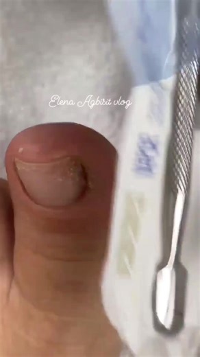 8.1K views · 40 reactions | Cute toenail #ingrown #followers #reelsvideo | Elena Agbisit Vlog | Facebook